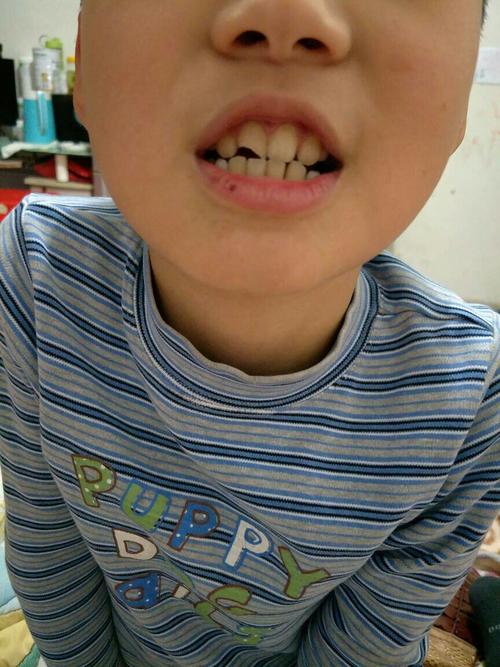 小孩9岁上门牙崩断了5分之1,请问怎样才能补救回来