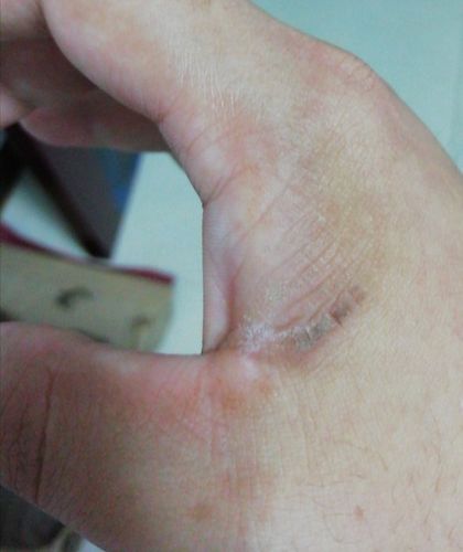 手指虎口有伤疤不知道对找工作影响吗,不知道该怎么消除